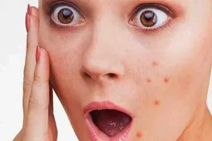 @f-Ilustrasi-Jerawat